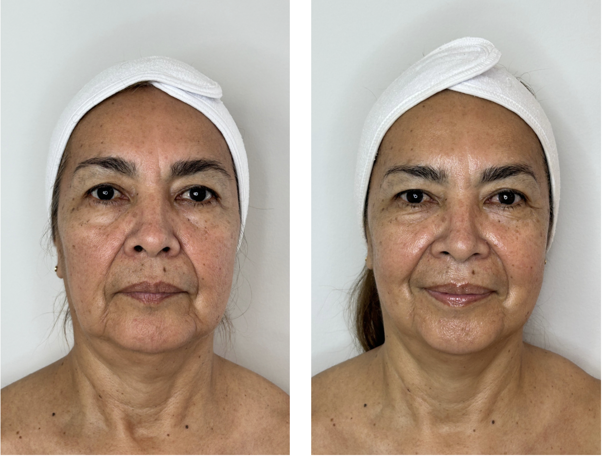 After Oxylight Treatment