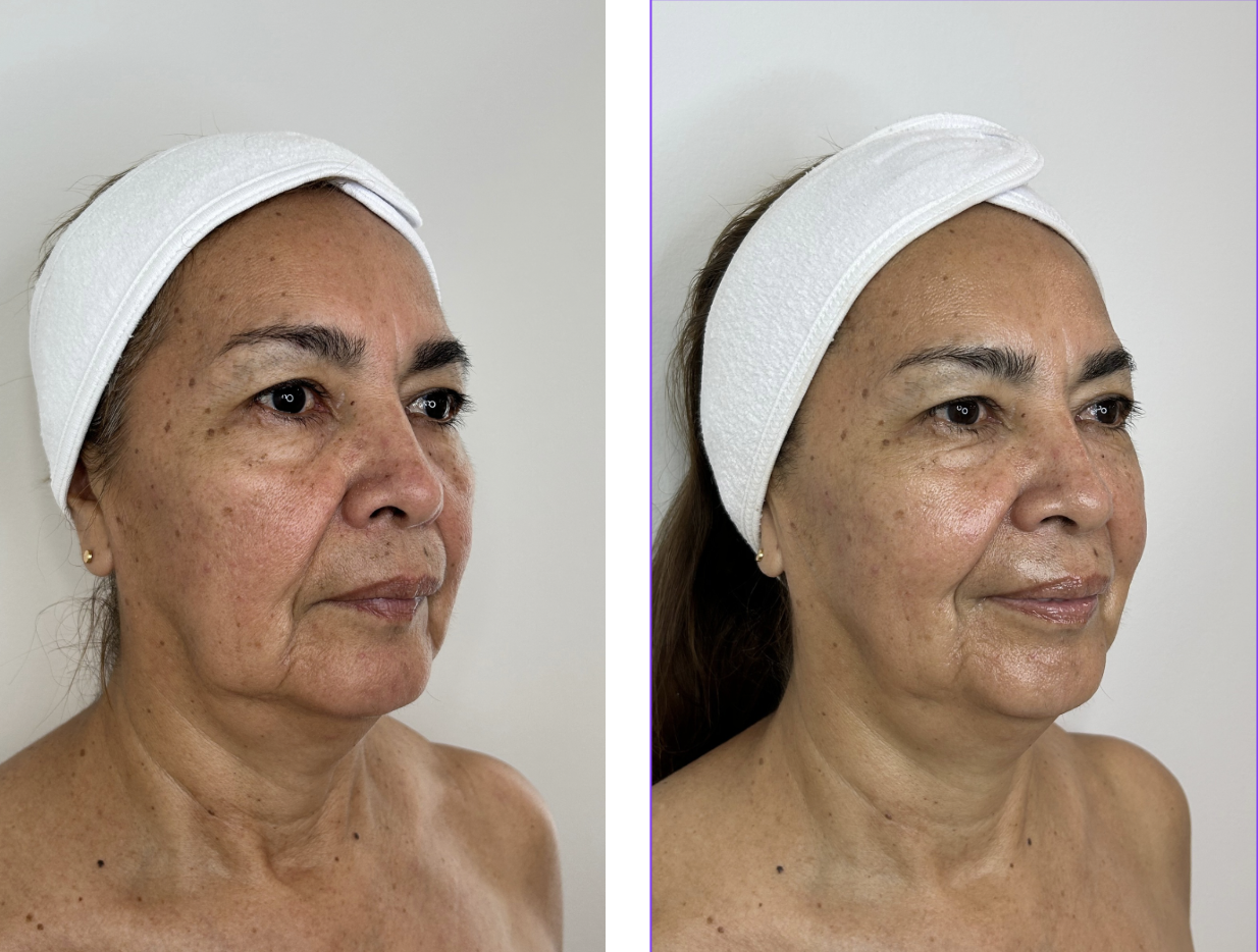 Before Oxylight Treatment